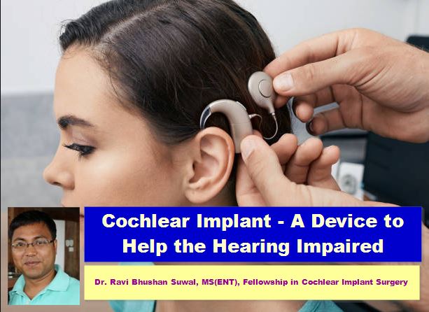 Cochlear Implant-A Device to Help the Hearing Impaired